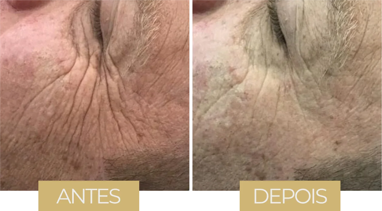 Toxina Botulínica LVB — antes e depois, caso 2