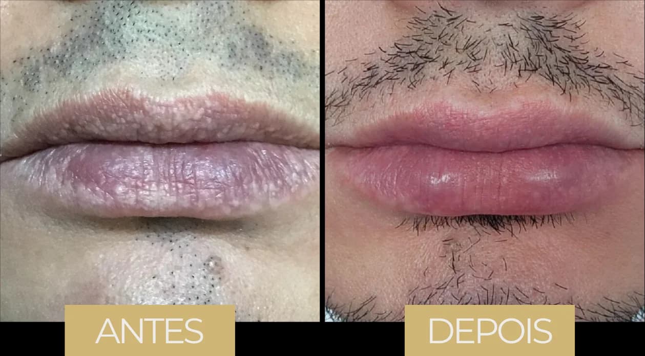 Fordyce por LVB — antes e depois, caso 1