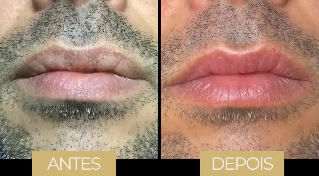 Fordyce por LVB — antes e depois, caso 2