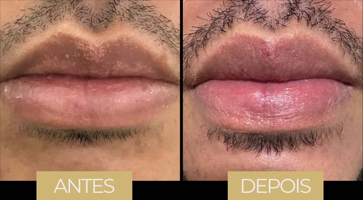 Fordyce por LVB — antes e depois, caso 6