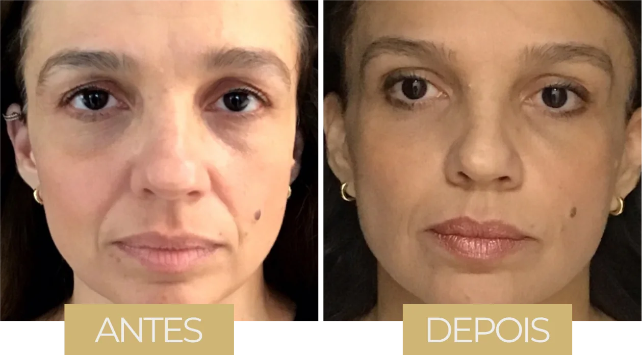 MD Codes — antes e depois, caso 2