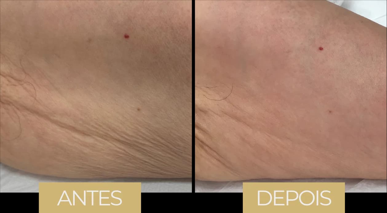 NuEra Tight — antes e depois, caso 1