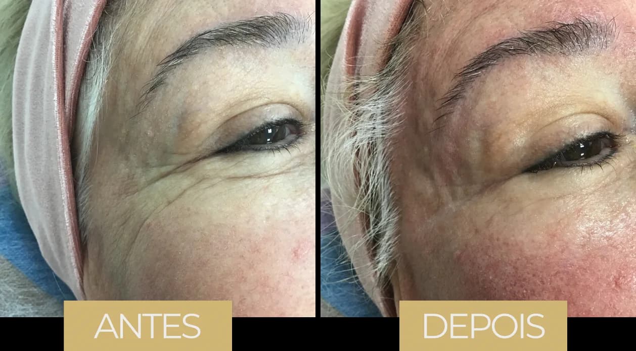 NuEra Tight — antes e depois, caso 2