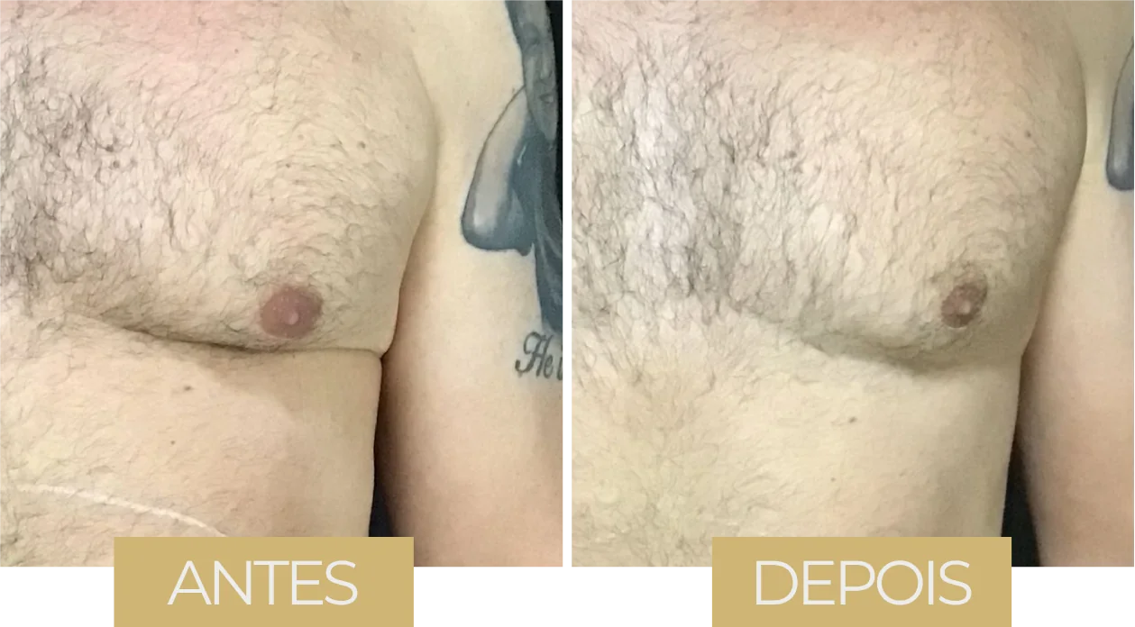 Ultraformer MPT — antes e depois, caso 1
